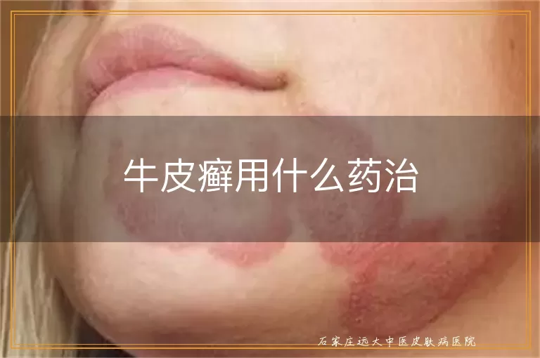 牛皮癣用什么药治
