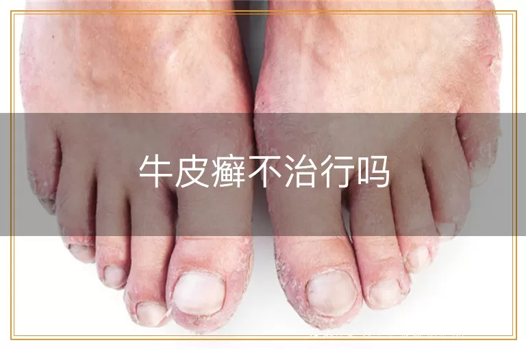 牛皮癣不治行吗