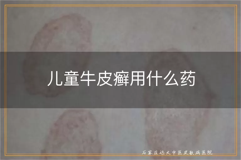 儿童牛皮癣用什么药