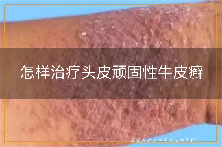 怎样治疗头皮顽固性牛皮癣