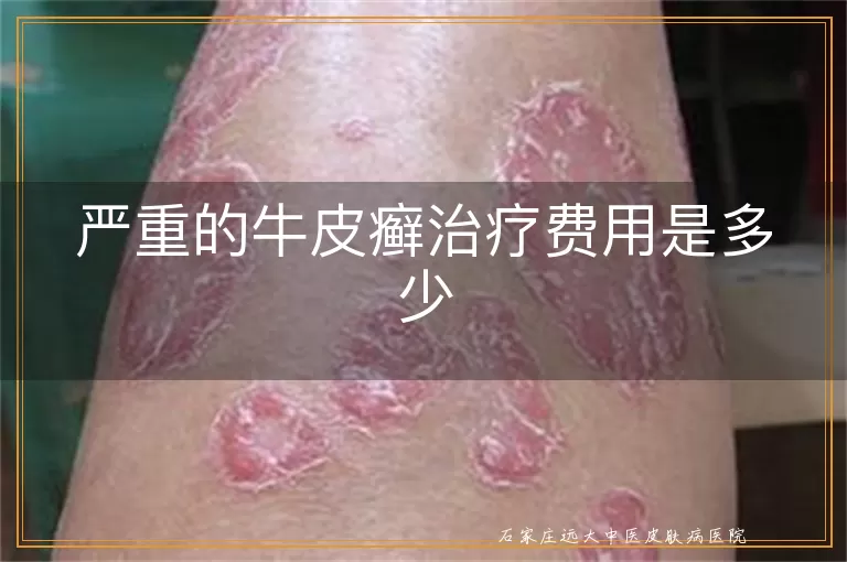 严重的牛皮癣治疗费用是多少