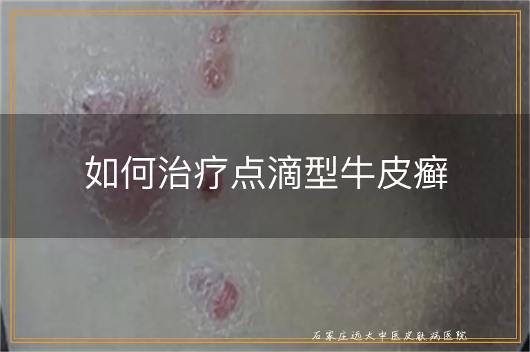 如何治疗点滴型牛皮癣