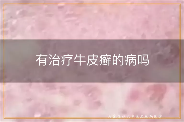 有治疗牛皮癣的病吗