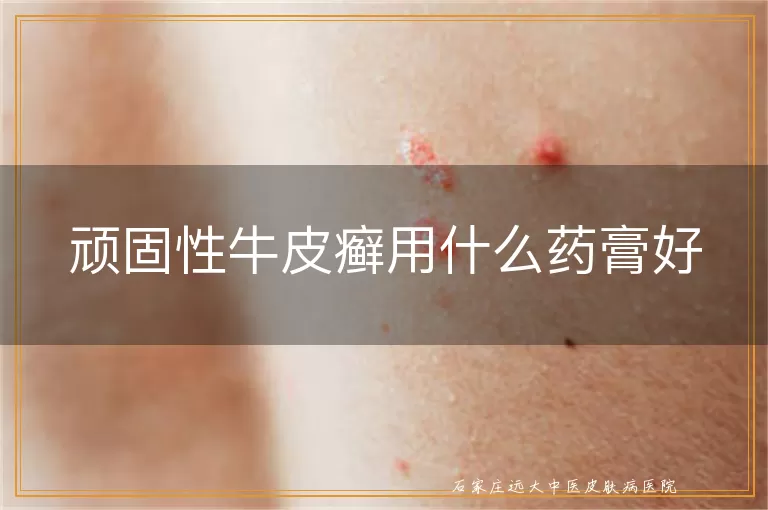 顽固性牛皮癣用什么药膏好