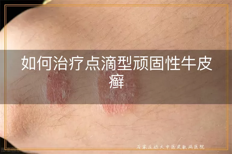 如何治疗点滴型顽固性牛皮癣