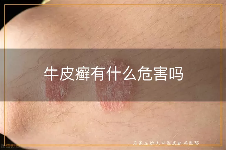 牛皮癣有什么危害吗