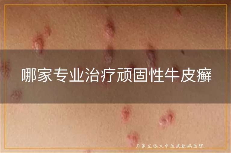 哪家专业治疗顽固性牛皮癣