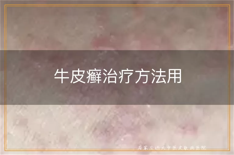 牛皮癣治疗方法用