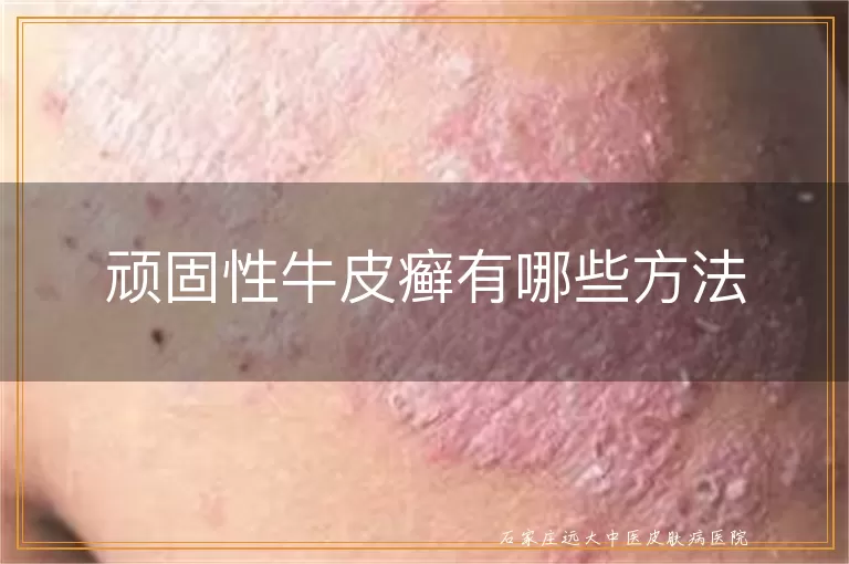 顽固性牛皮癣有哪些方法