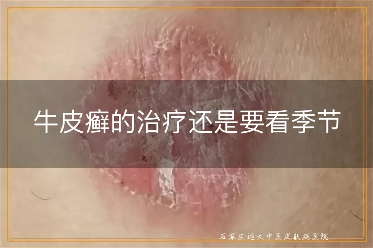 牛皮癣的治疗还是要看季节