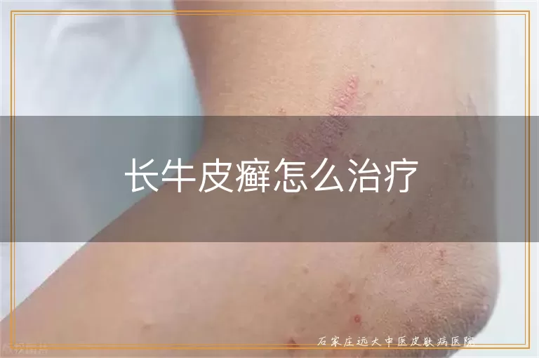 长牛皮癣怎么治疗