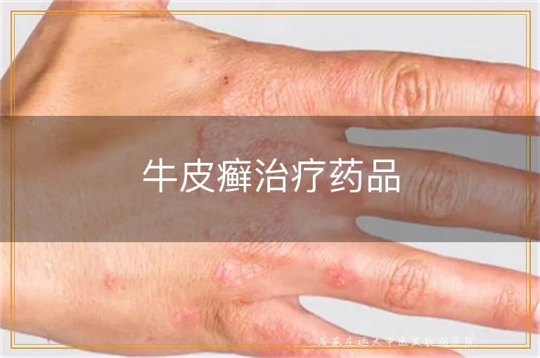 牛皮癣治疗药品
