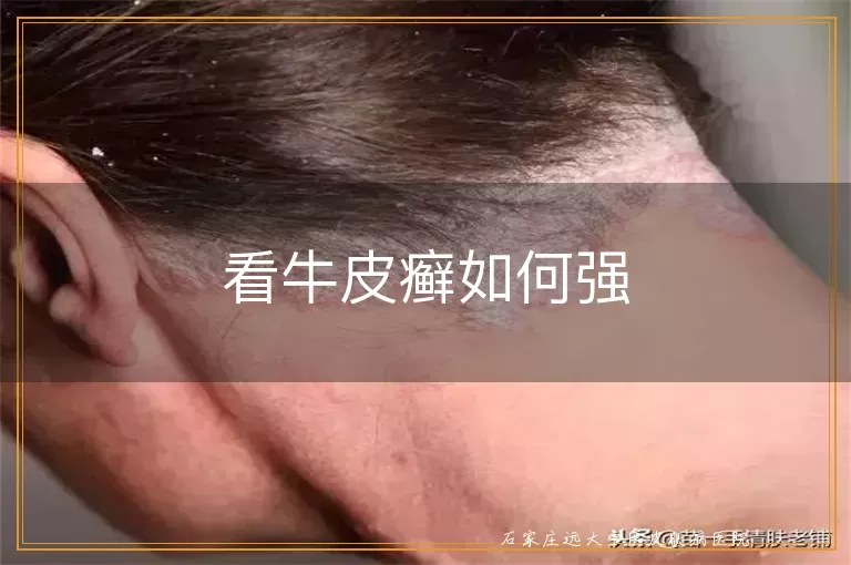 看牛皮癣如何强