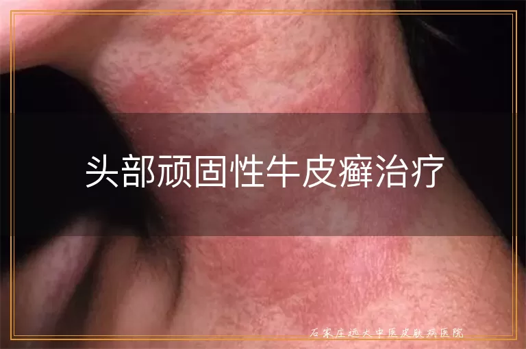 头部顽固性牛皮癣治疗