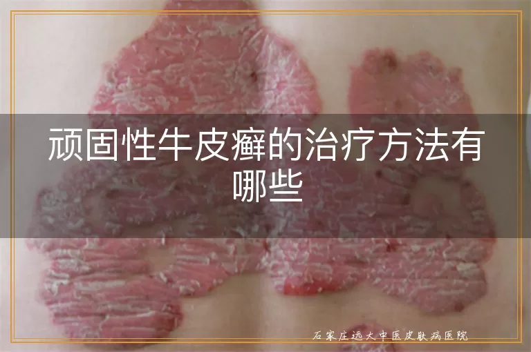 顽固性牛皮癣的治疗方法有哪些
