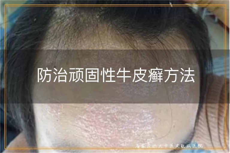 防治顽固性牛皮癣方法