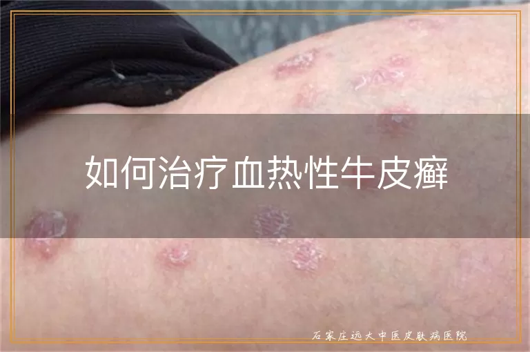 如何治疗血热性牛皮癣