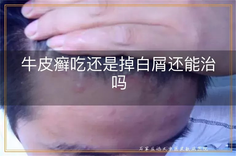 牛皮癣吃还是掉白屑还能治吗