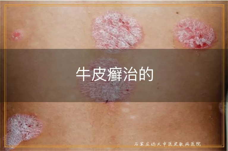 牛皮癣治的
