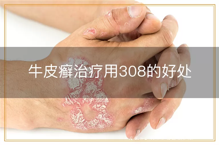 牛皮癣治疗用308的好处