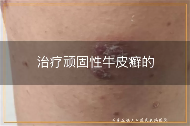 治疗顽固性牛皮癣的