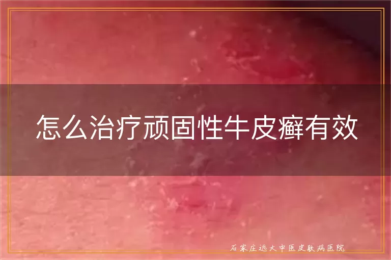 怎么治疗顽固性牛皮癣有效