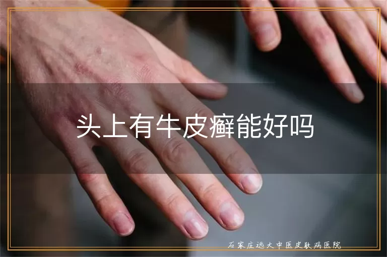 头上有牛皮癣能好吗