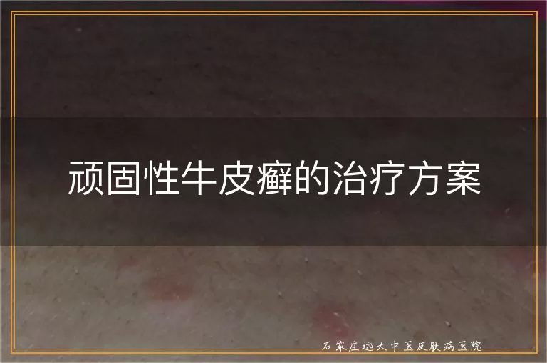 顽固性牛皮癣的治疗方案