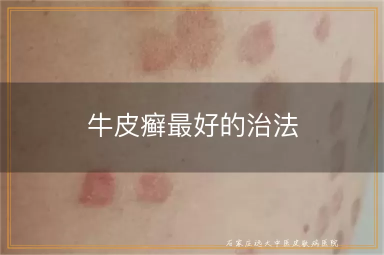 牛皮癣最好的治法