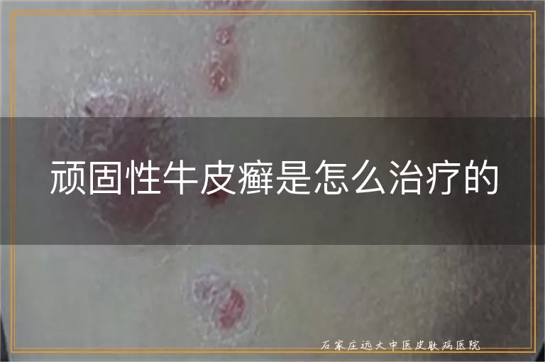 顽固性牛皮癣是怎么治疗的