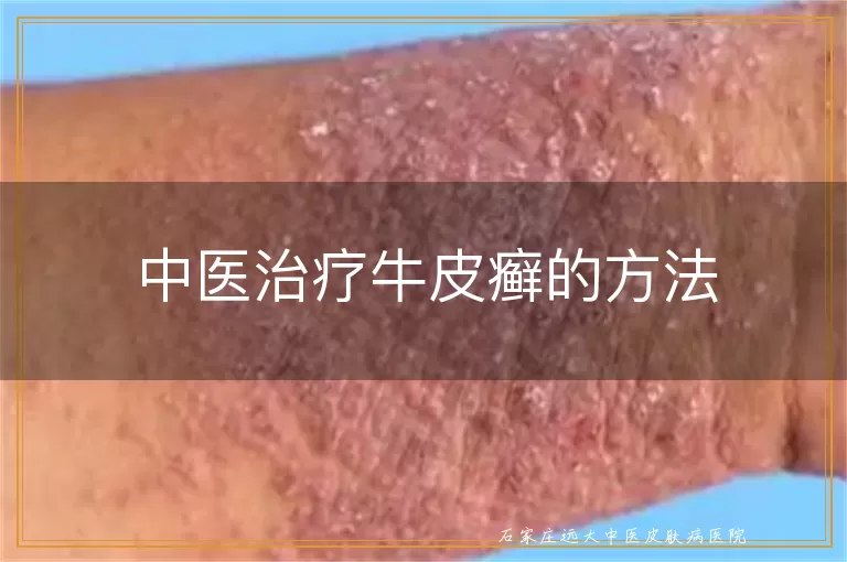 中医治疗牛皮癣的方法