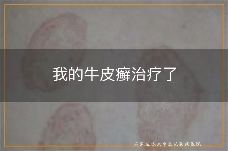 我的牛皮癣治疗了