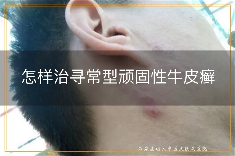 怎样治寻常型顽固性牛皮癣