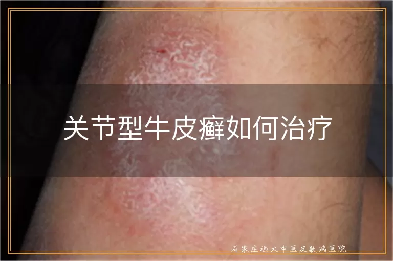 关节型牛皮癣如何治疗