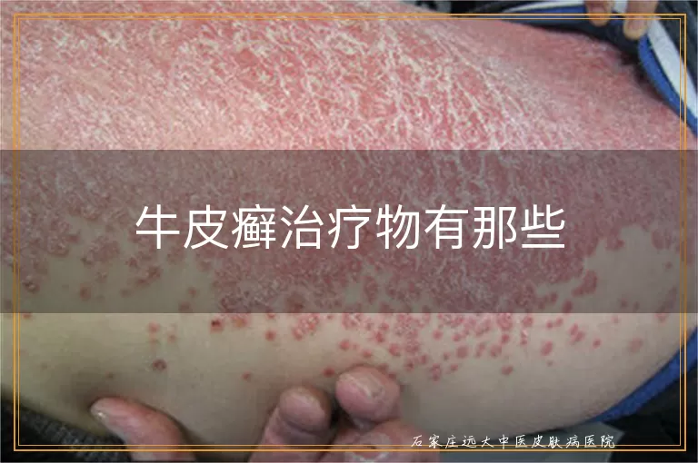 牛皮癣治疗物有那些