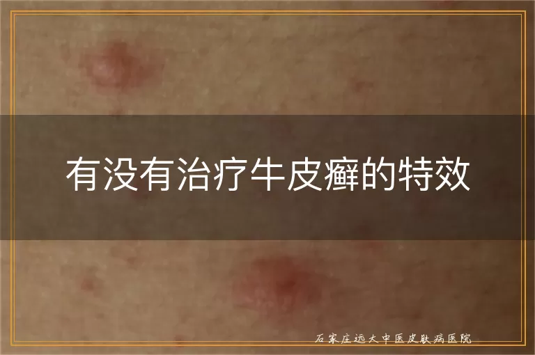 有没有治疗牛皮癣的特效