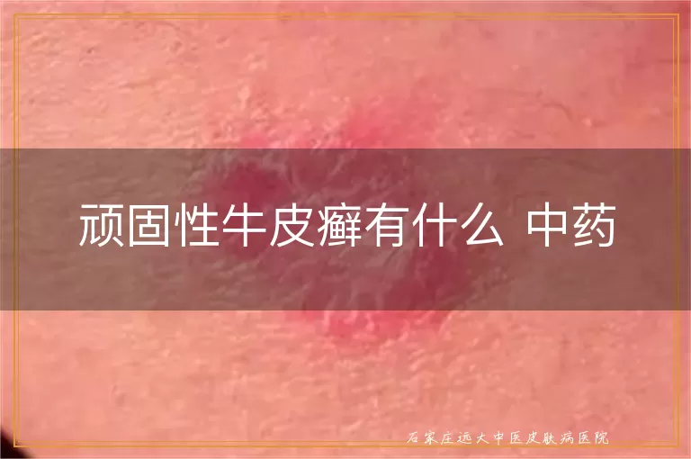 顽固性牛皮癣有什么 中药
