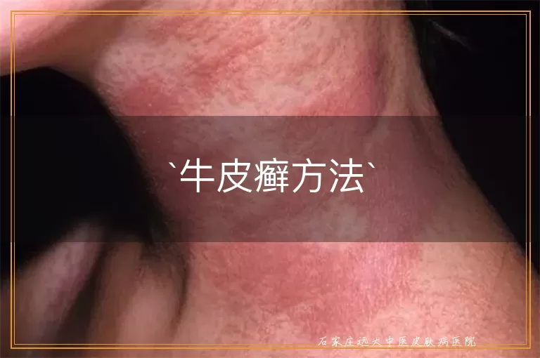 牛皮癣方法