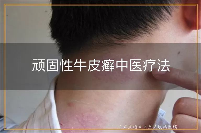 顽固性牛皮癣中医疗法