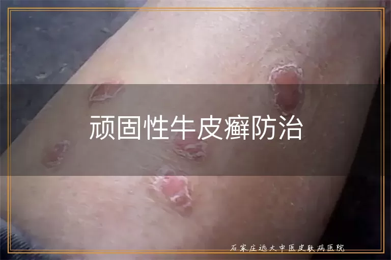 顽固性牛皮癣防治