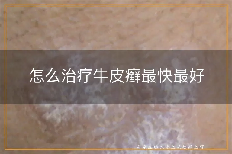 怎么治疗牛皮癣最快最好
