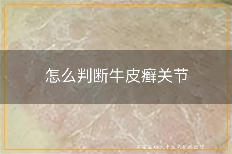 怎么判断牛皮癣关节