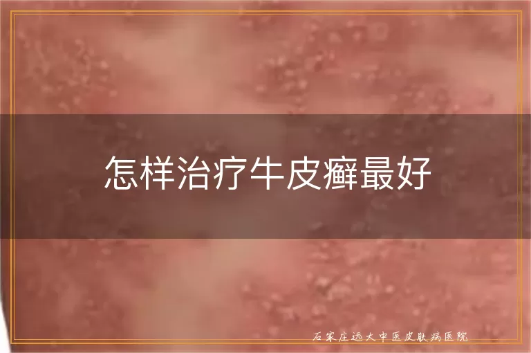 怎样治疗牛皮癣最好