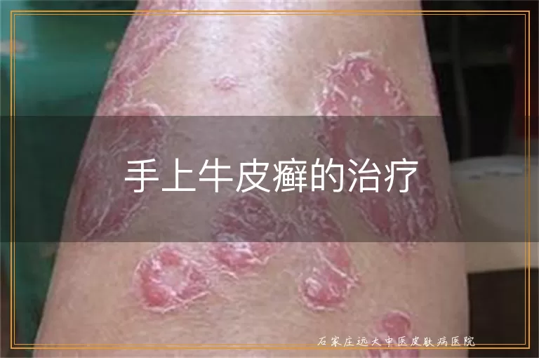 手上牛皮癣的治疗