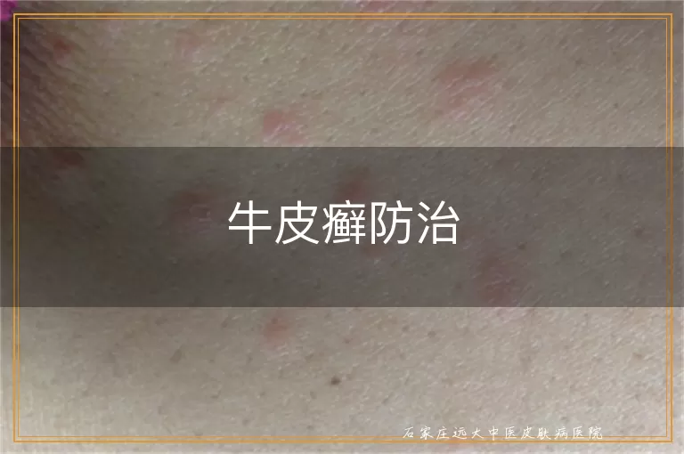 牛皮癣防治