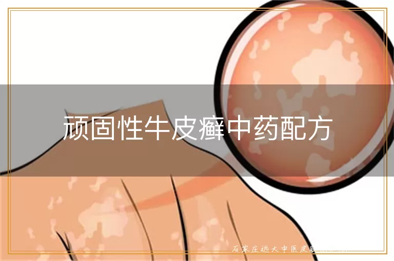 顽固性牛皮癣中药配方