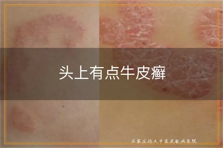 头上有点牛皮癣