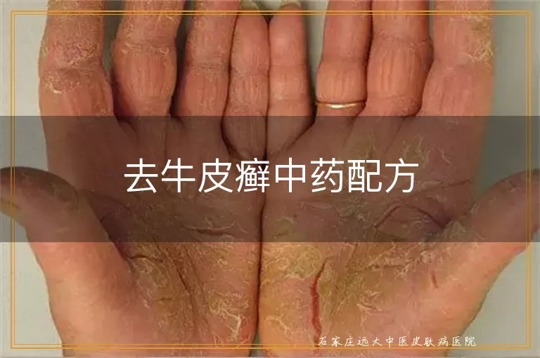 去牛皮癣中药配方