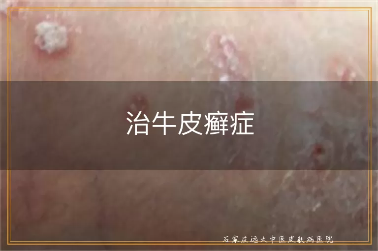 治牛皮癣症