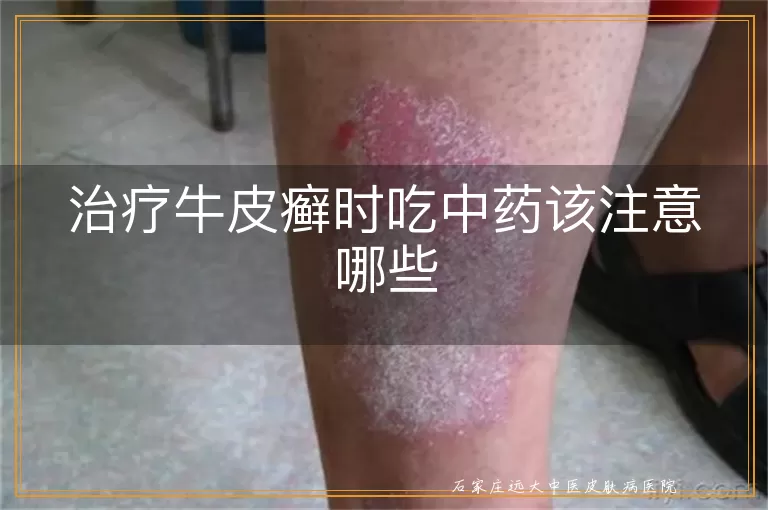 治疗牛皮癣时吃中药该注意哪些